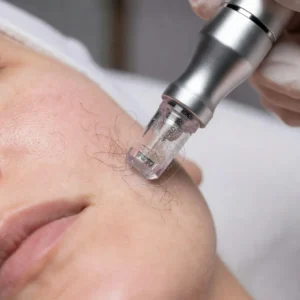 Does Microdermabrasion Remove Hair? The Real Answer