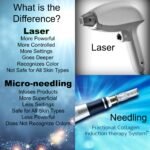 Is RF Microneedling Better Than Laser?