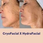 Cryo Facial Vs Hydrafacial