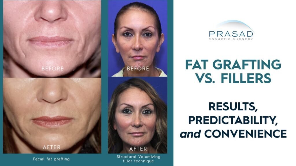 Facial Fat Transfer Vs Fillers