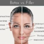 Facial Fillers Vs Botox