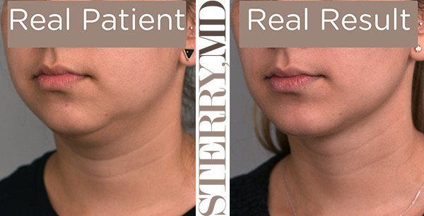 Facial Liposuction Vs Buccal Fat Extraction