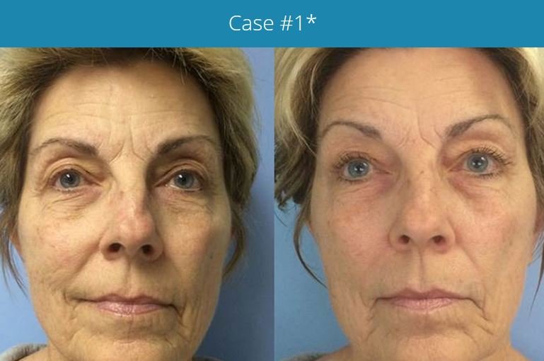 What is Led Anti Aging Facial?