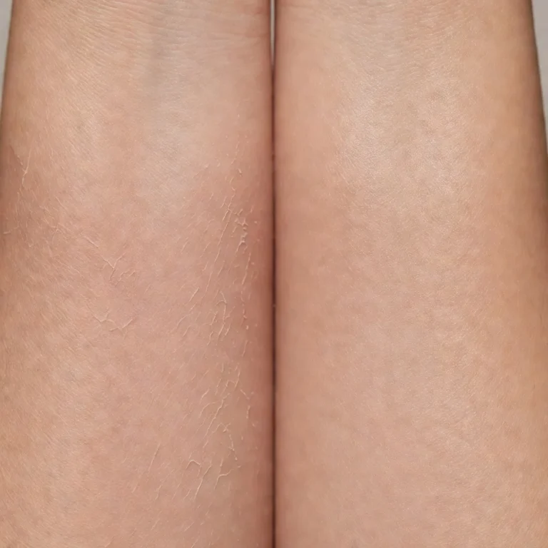 Does Skipping Moisturizer Damage Barrier? Essential Facts Revealed